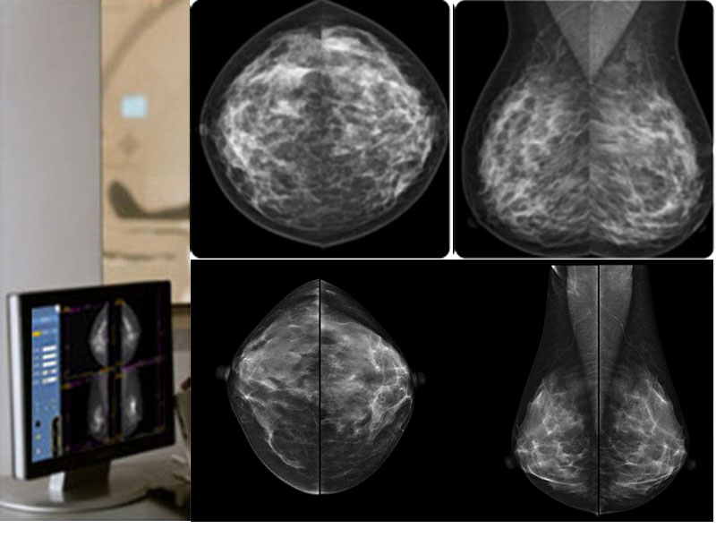 Mammography